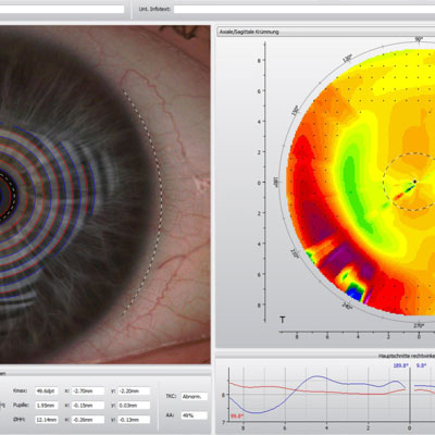 Messtechnik Hornhautscan für Kontaktlinsen